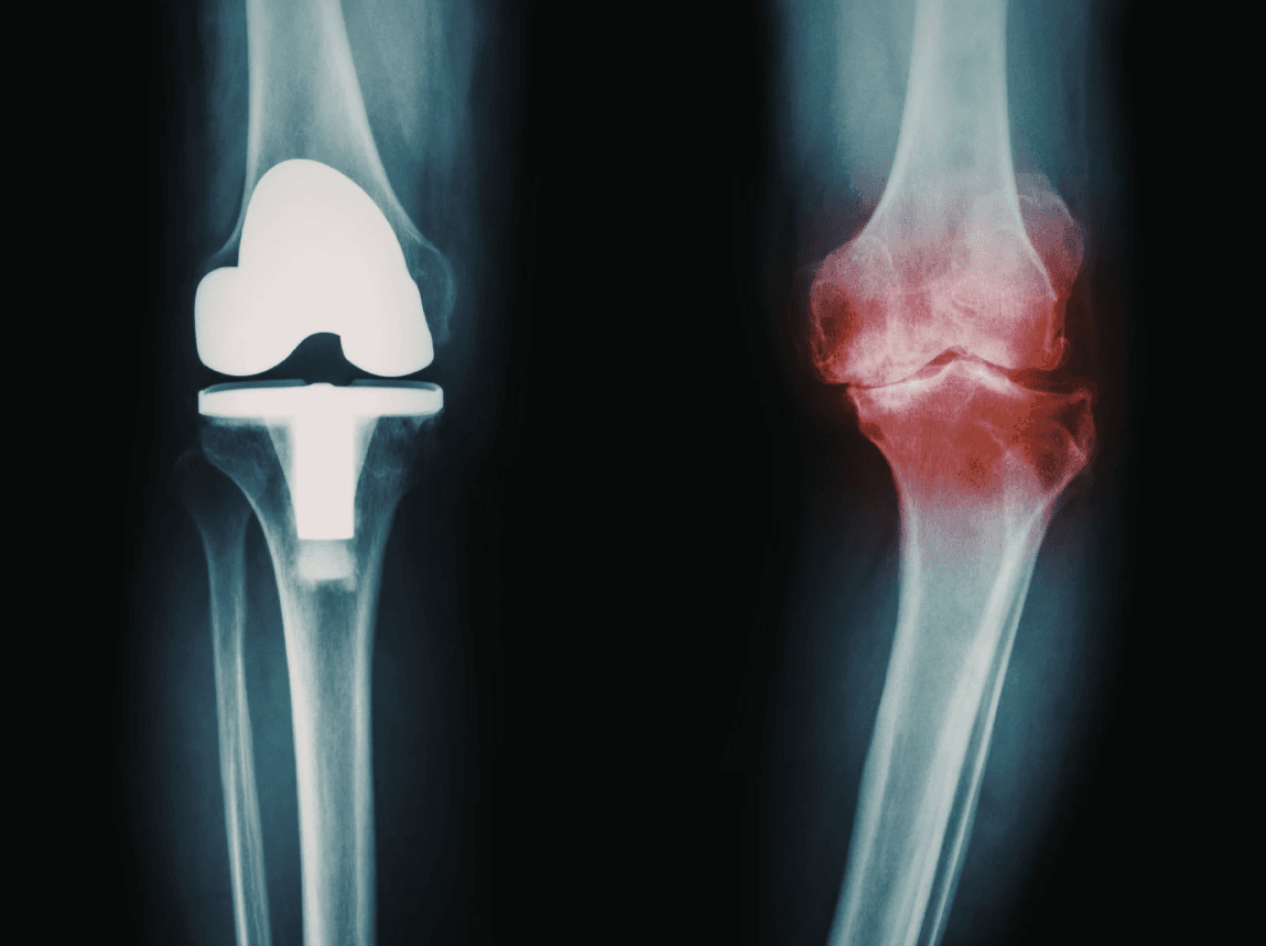 Shoulder or Knee Pain After a Dallas Car Accident: When MRI and Orthopedics Matter