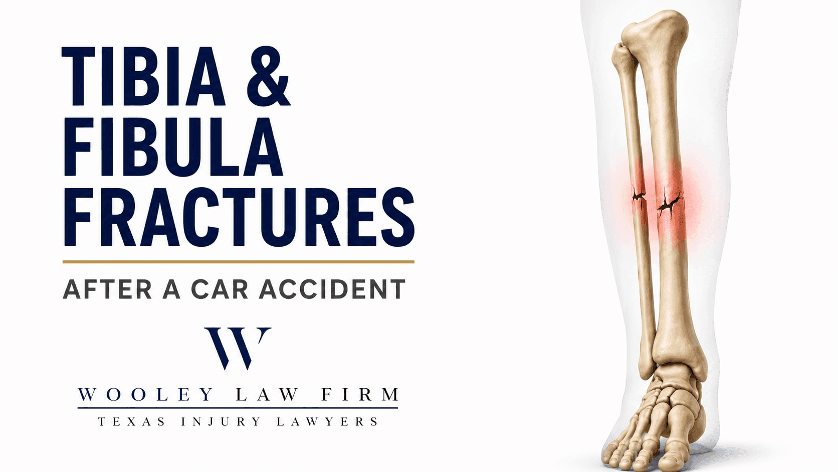 Tibia and Fibula Fractures After a Dallas Car Accident: What Victims Need to Know